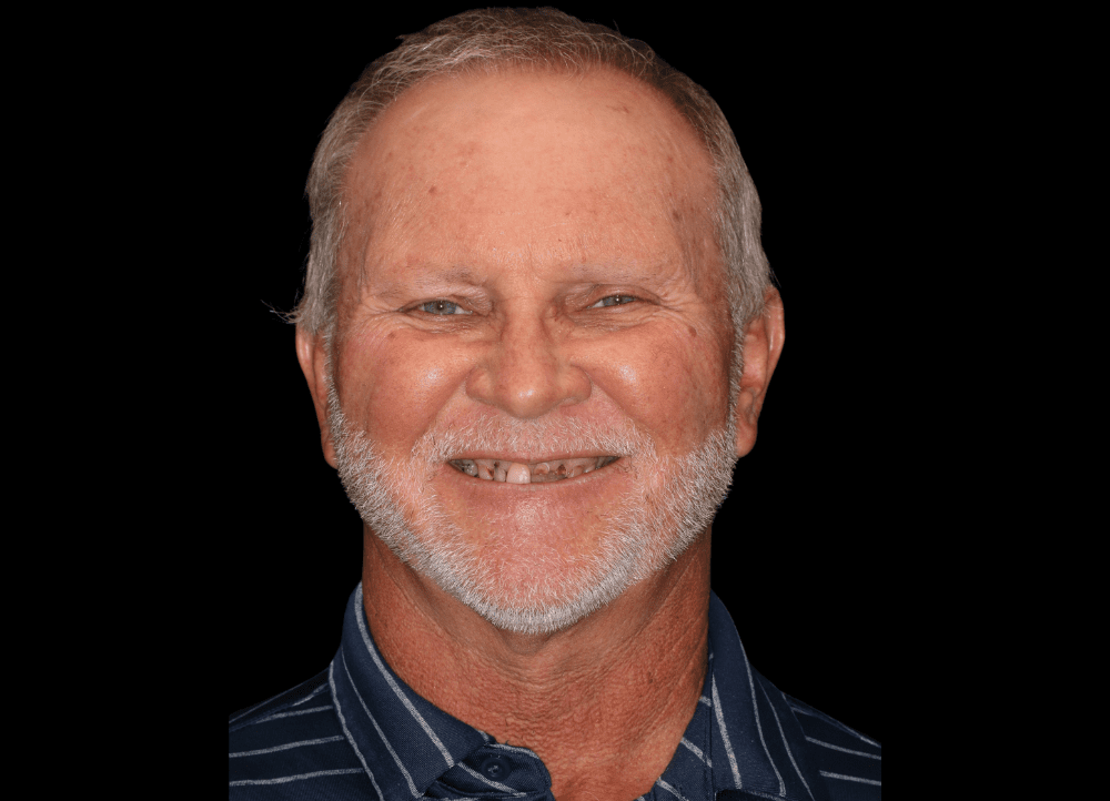 Dental implants texas