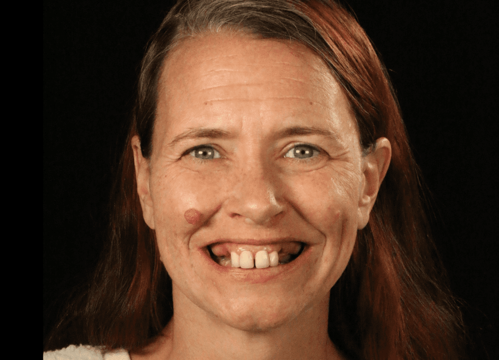 before dental implants