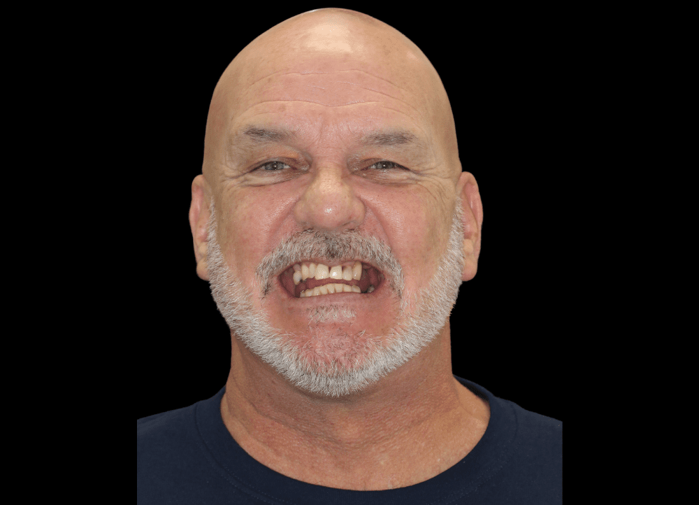 dental implants texas